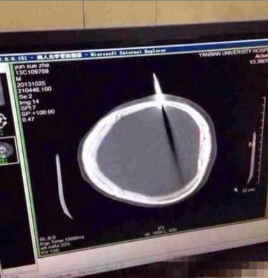 男子头插水果刀一人到医院“淡定”就医(图)390 / 作者:狗掰涛 / 帖子ID:97207