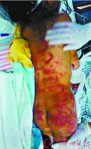 衣架教子再生悲剧 5岁女童遭毒打脑梗死亡345 / 作者:小雨点 / 帖子ID:101297