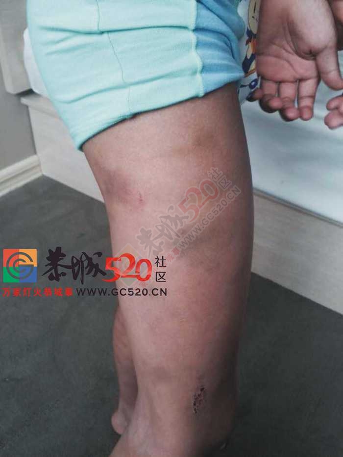 惊爆！恭城江南双语实验学校（地址：在原党校）学生被群殴！家长讨公道无果！84 / 作者:520小编 / 帖子ID:116807