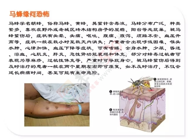 病危！广西4岁女童被马蜂蜇了140处！275 / 作者:太天真 / 帖子ID:128284