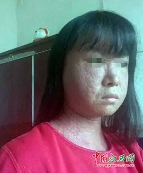 家长注意！小孩脸上红通彤彤要留心，可能危及生命！633 / 作者:渲染人生 / 帖子ID:160336