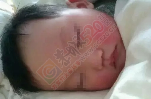 家长注意！小孩脸上红通彤彤要留心，可能危及生命！555 / 作者:渲染人生 / 帖子ID:160336