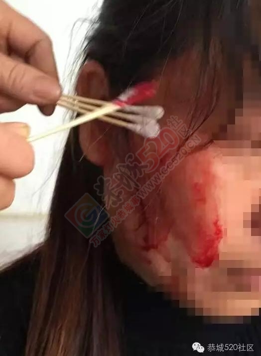 吓懵了！网友坐班车从治平回恭城途中被不明飞行物射穿车窗击中头部血流满面156 / 作者:深秋的落叶 / 帖子ID:185882