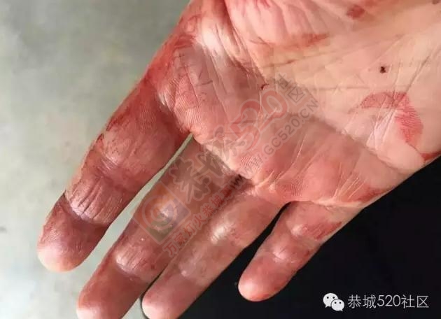 吓懵了！网友坐班车从治平回恭城途中被不明飞行物射穿车窗击中头部血流满面529 / 作者:深秋的落叶 / 帖子ID:185882