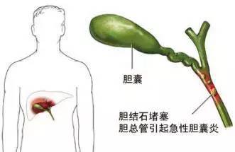 饿一顿饱一顿，最受伤的竟然不是胃而是……11 / 作者:疾控客服 / 帖子ID:235160