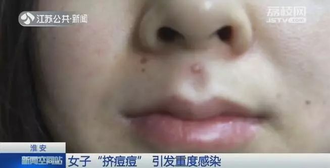 挤了颗痘痘，高烧昏迷进ICU！别再手欠了啊啊啊啊65 / 作者:单身汉子 / 帖子ID:267748