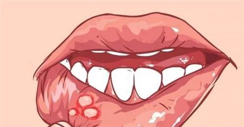 口腔溃疡很疼怎么办？这里有一些小妙招~632 / 作者:雨云儿 / 帖子ID:273512