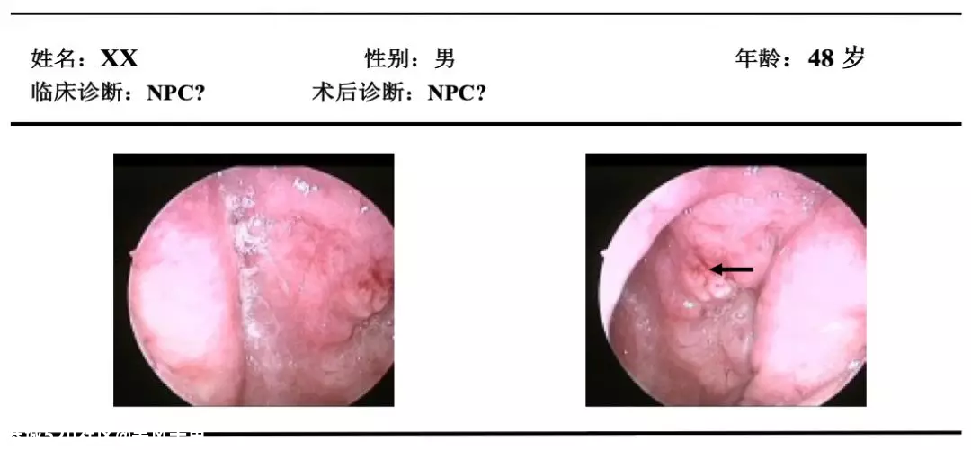 鼻咽癌，为什么中国的患病人数全球第一？146 / 作者:等风十里 / 帖子ID:276064