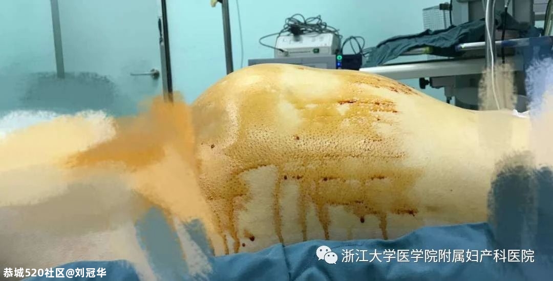 13岁女孩肚子一天天隆起，妈妈反复追问：是不是怀孕了？检查结果惊出冷汗…598 / 作者:刘冠华 / 帖子ID:276847
