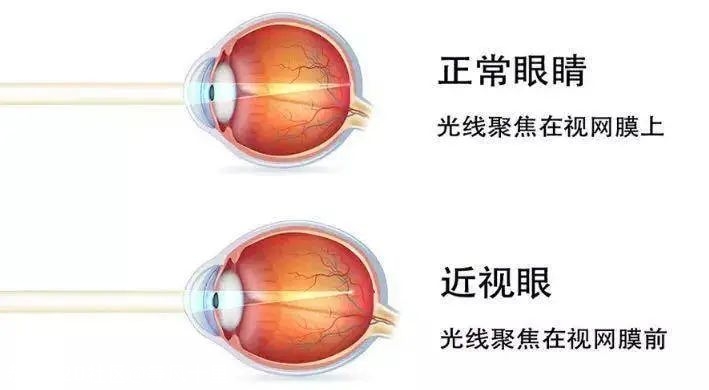 视力矫正太坑人！盘点 7 种超火方法，当心白花钱还伤眼睛62 / 作者:等风十里 / 帖子ID:277013