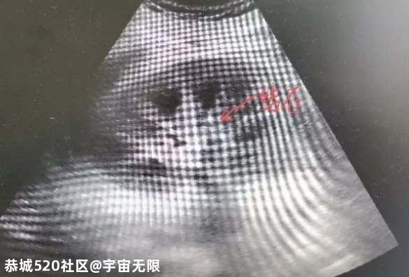 00后小伙突然肚痛拉肚子，几乎没尿了...一查，祸首竟是...295 / 作者:宇宙无限 / 帖子ID:277521