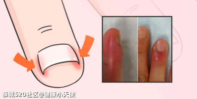 指甲别留长，剪得越短越干净？910 / 作者:健康小天使 / 帖子ID:283187