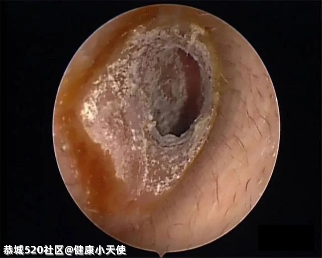 采耳撩出“蘑菇”？恭城人要小心！259 / 作者:健康小天使 / 帖子ID:284998