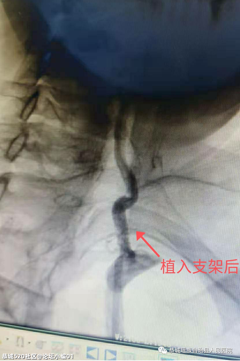 小针口大疗效，必要时可救命〡恭城只有这里能做，别不知道！201 / 作者:论坛小编01 / 帖子ID:286048