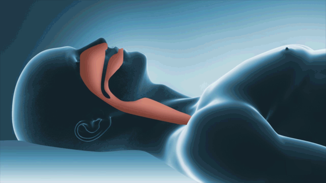 如果不去治疗，长期「打呼噜」会有什么后果？831 / 作者:健康小天使 / 帖子ID:287365