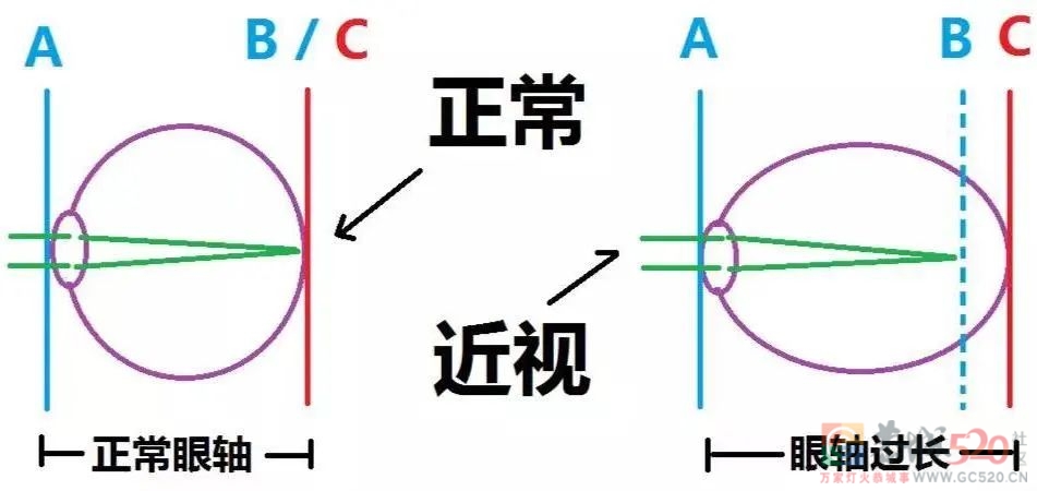 近视度数高的人，你的眼底可能已经「裂」了828 / 作者:健康小天使 / 帖子ID:296393