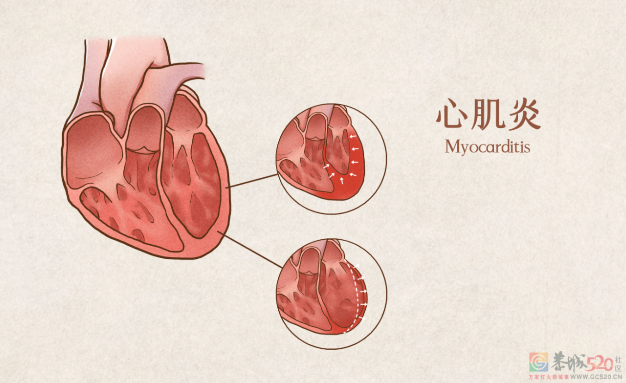 其实，世界上没有「治愈感冒」的感冒药817 / 作者:健康小天使 / 帖子ID:299198