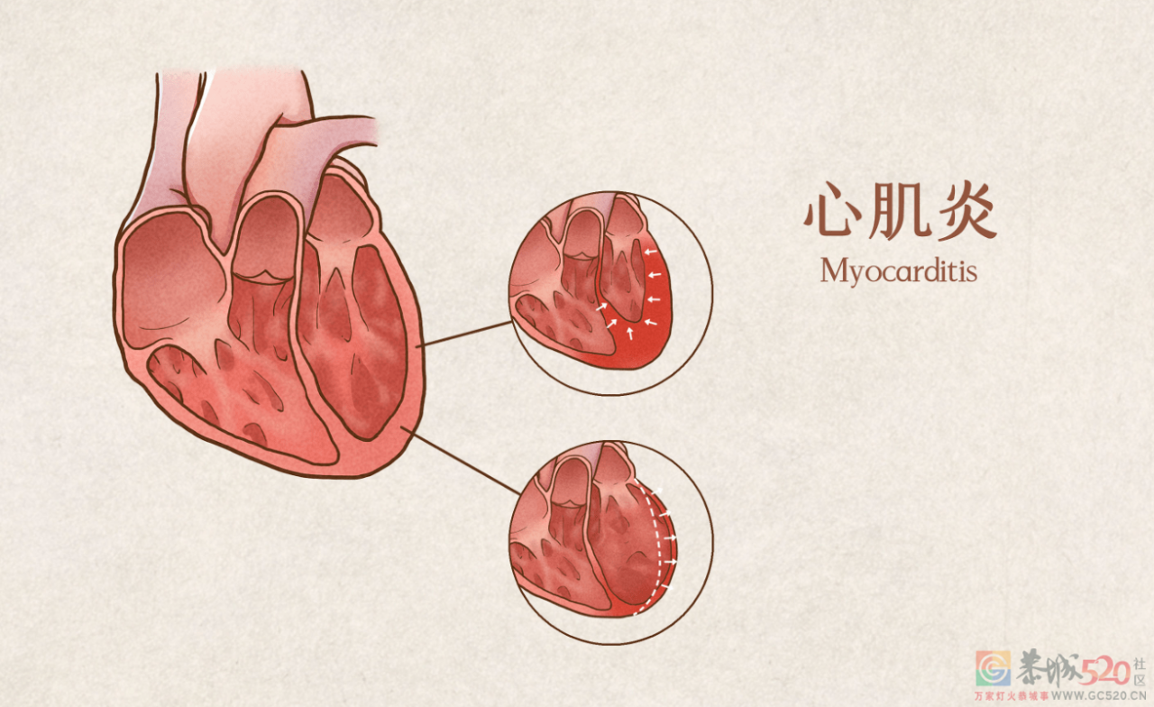 其实，世界上没有「治愈感冒」的感冒药72 / 作者:健康小天使 / 帖子ID:299198