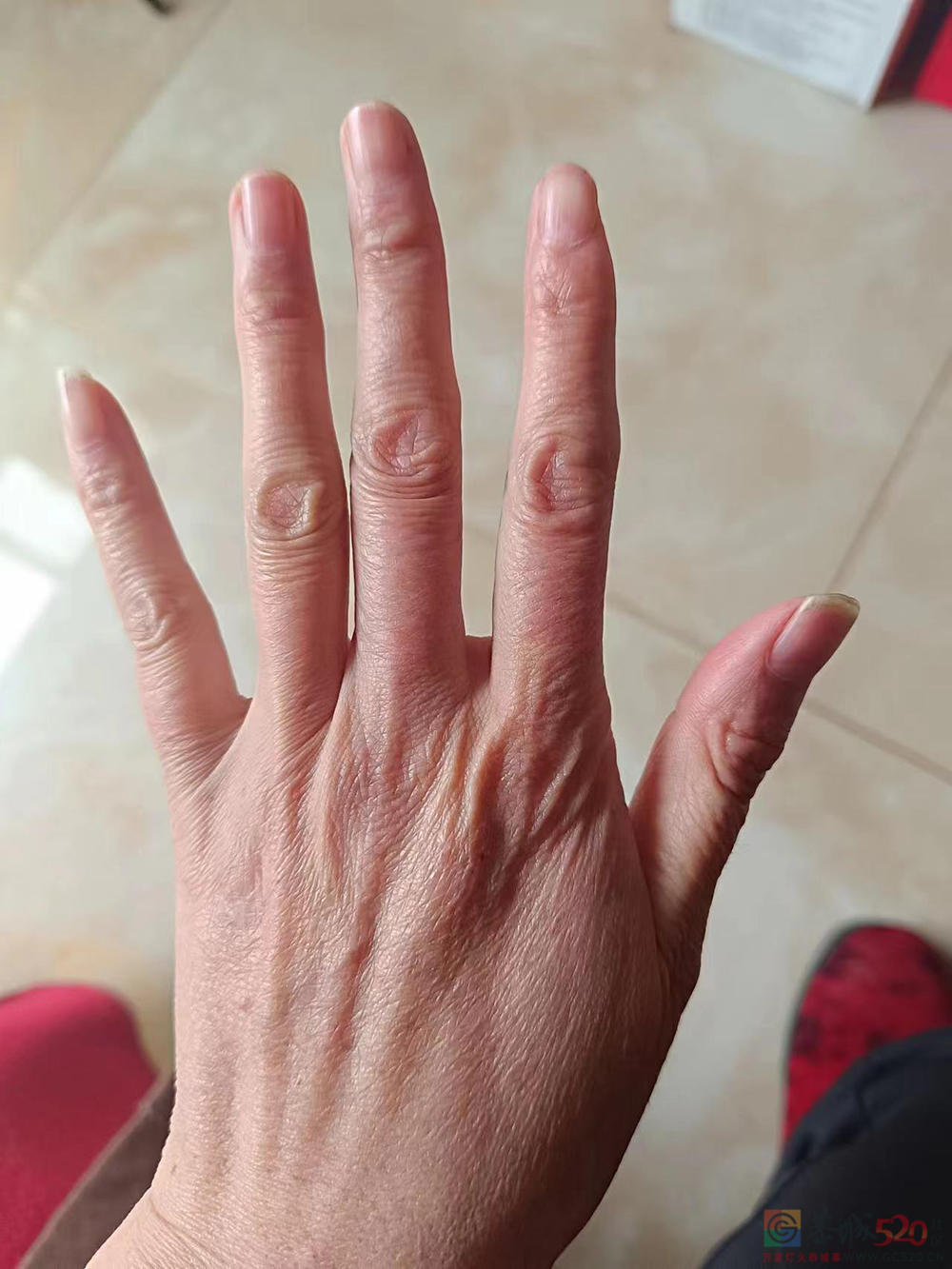 “我们也没想到，43码的脚，竟然是种病”423 / 作者:登山涉水 / 帖子ID:304641