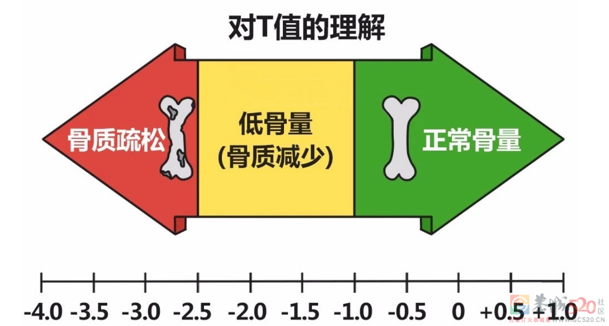 骨质疏松的危害被低估了！骨头脆，易诱发全身感染472 / 作者:健康小天使 / 帖子ID:305883