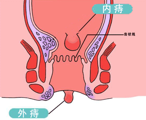 开工3天痔疮膏销量翻倍，中医：立春后要“防痔”165 / 作者:健康小天使 / 帖子ID:313764