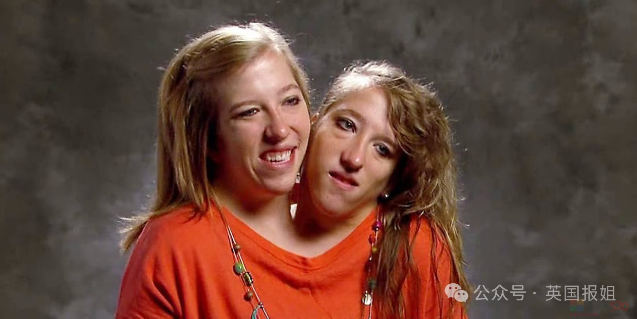 美国连体双胞胎嫁给同一个男人！共用身体34年，还要一起生孩子？897 / 作者:放眼看世界 / 帖子ID:314448