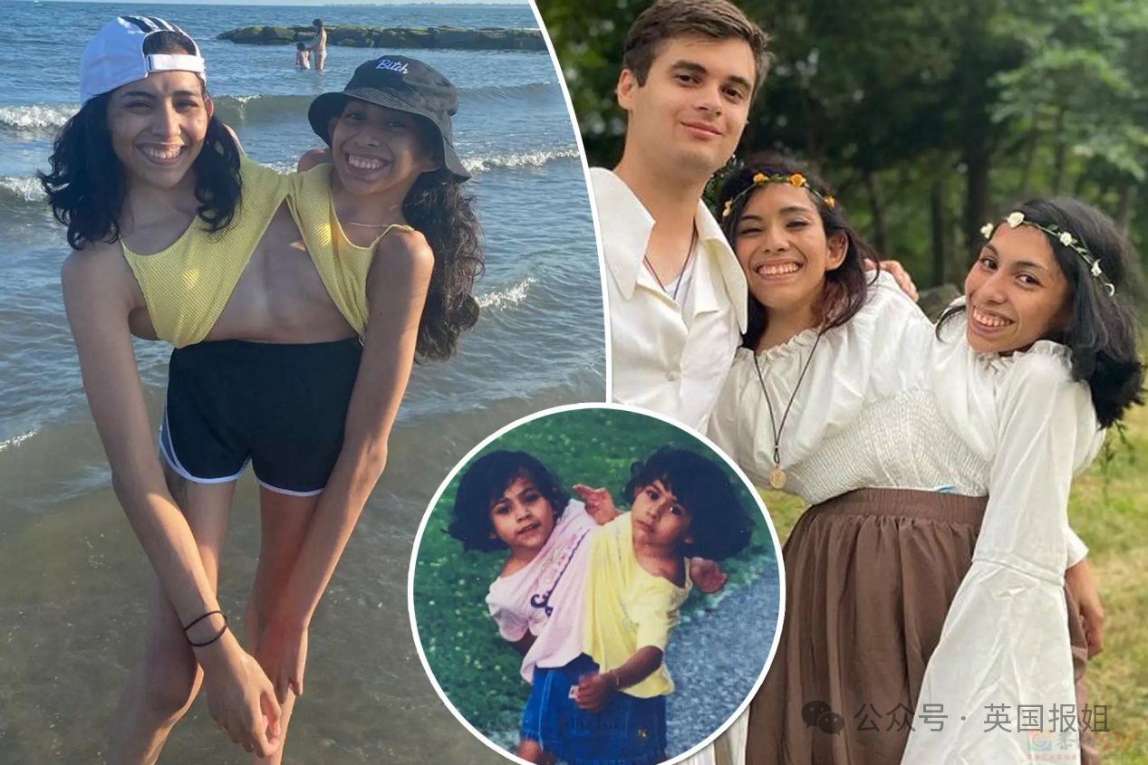 美国连体双胞胎嫁给同一个男人！共用身体34年，还要一起生孩子？468 / 作者:放眼看世界 / 帖子ID:314448