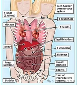 美国连体双胞胎嫁给同一个男人！共用身体34年，还要一起生孩子？235 / 作者:放眼看世界 / 帖子ID:314448
