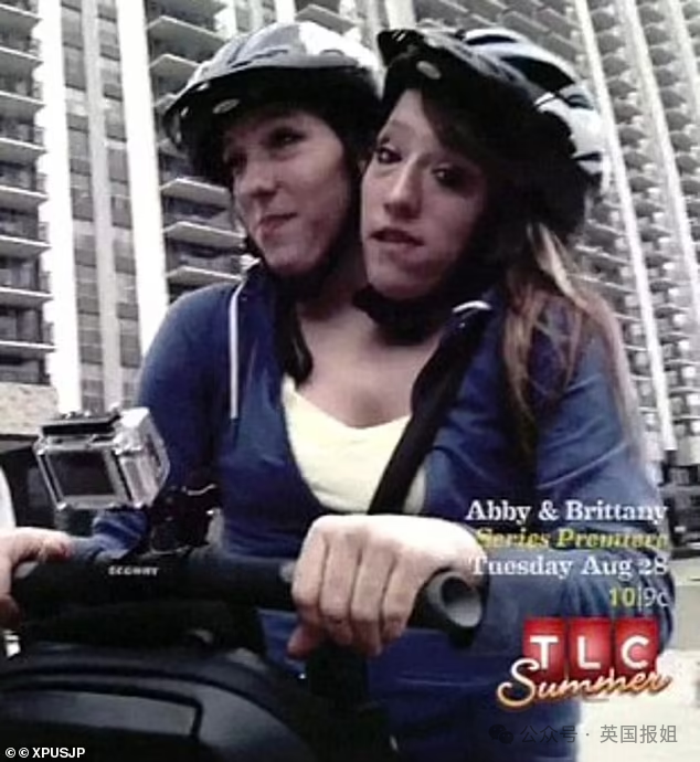 美国连体双胞胎嫁给同一个男人！共用身体34年，还要一起生孩子？168 / 作者:放眼看世界 / 帖子ID:314448