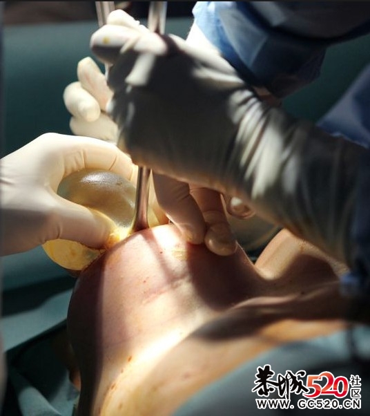 关于美女隆胸内幕972 / 作者:黑木耳 / 帖子ID:6744