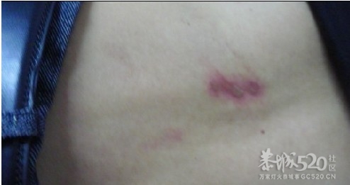 越参战老兵林广和（战场一等功臣）老兄，看到你的悲惨遭遇，我悚然泪下（转载）556 / 作者:孤单远行 / 帖子ID:15440