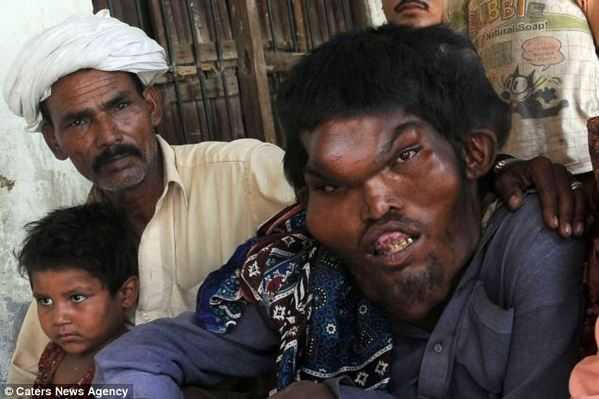 巴基斯坦惊现真实版“象人”26 / 作者:美特斯邦威 / 帖子ID:19548