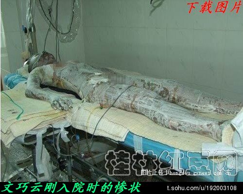 兴安学生打工妹烧伤一案一审获赔93万元。434 / 作者:平安大叔 / 帖子ID:19980