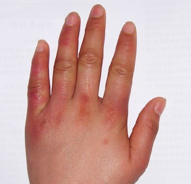 [转] 手冻了怎么办？739 / 作者:小雨点 / 帖子ID:60857