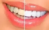 牙齿黄黄的， 不用洗牙，教你5分钟消灭牙垢！真的很实用。。536 / 作者:分叉路口 / 帖子ID:128588