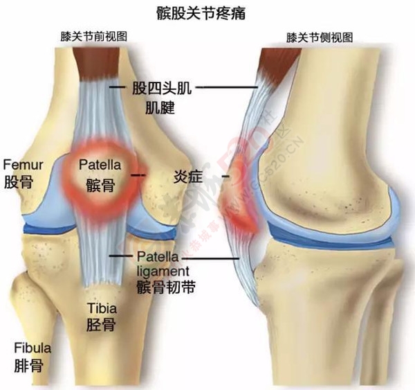 女性更易患“跑步膝”？897 / 作者:健康小天使 / 帖子ID:160451