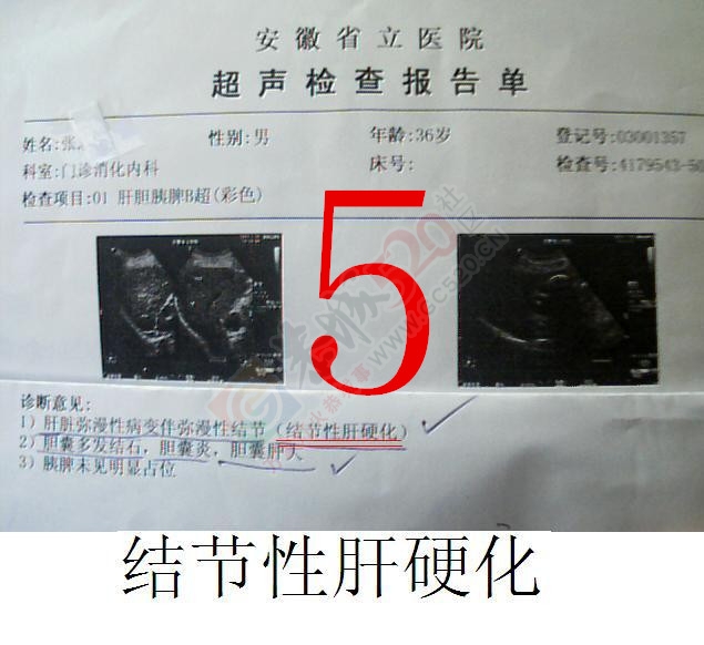 贡献百草奇药截解肝硬化890 / 作者:时珍后人 / 帖子ID:160511