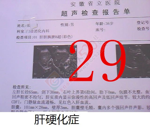 贡献百草奇药截解肝硬化111 / 作者:时珍后人 / 帖子ID:160511