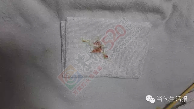 恐怖！南宁阿婆眼里长了一条7厘米长的虫！658 / 作者:渲染人生 / 帖子ID:160752