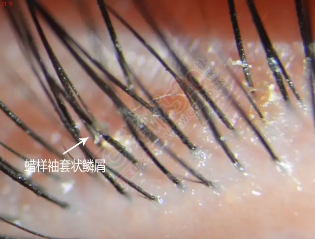 恐怖！南宁阿婆眼里长了一条7厘米长的虫！43 / 作者:渲染人生 / 帖子ID:160752