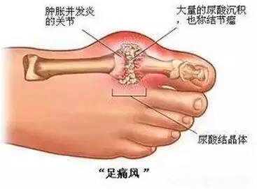 万万没想到痛风可以这样治.300 / 作者:人艰不拆 / 帖子ID:163420