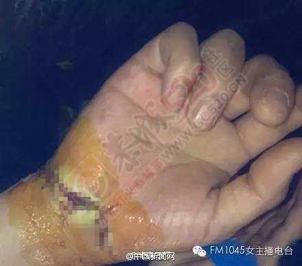 奇葩！梦到吃猪蹄，小伙竟把自己手啃得鲜血淋漓...664 / 作者:该做的事情 / 帖子ID:163680