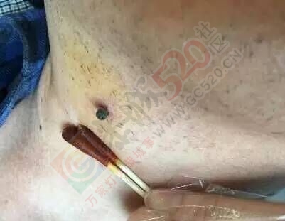 注意！这种恐怖的小虫开始活跃了，被咬一口或可致命！663 / 作者:心交朋友钱交狗 / 帖子ID:168723