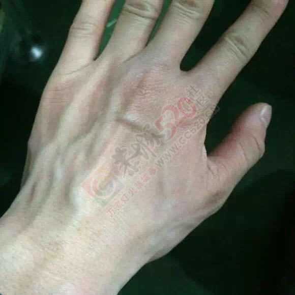 手上青筋凸出？其实是种病！恭城人千万要重视！150 / 作者:今日恭城 / 帖子ID:171831