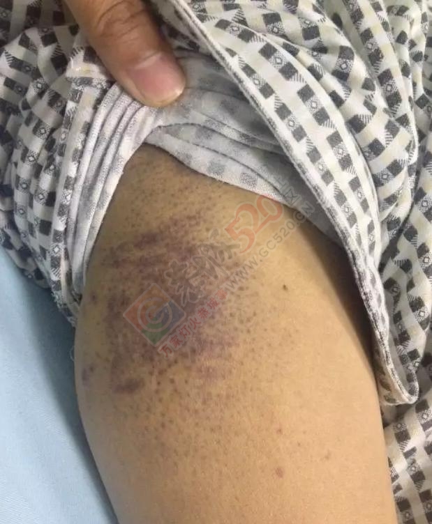 【爱心求助】恭城平安乡一位父亲身患白血病，请爱心人士帮忙,传递正能量！526 / 作者:以空。 / 帖子ID:176132