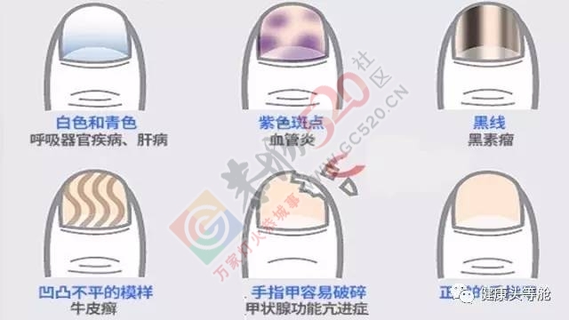从指甲美丑看健康771 / 作者:健康小天使 / 帖子ID:207399
