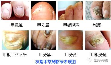从指甲美丑看健康191 / 作者:健康小天使 / 帖子ID:207399