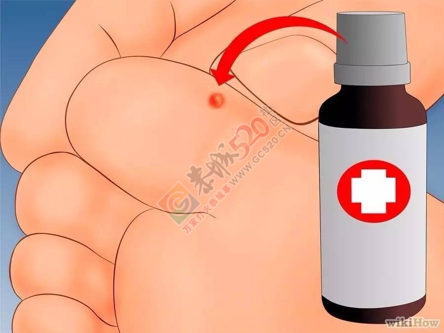健康之路 | 关于瘊子，你知道多少？563 / 作者:健康小天使 / 帖子ID:207503