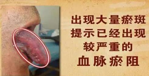 此处颜色越深，心脏血管堵得越厉害！逆转法在脚上，别错过~6 / 作者:健康小天使 / 帖子ID:207766