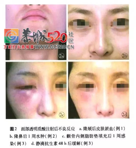 微整形还是“危整形”，不开刀的微整形安全吗？174 / 作者:疾控客服 / 帖子ID:235569